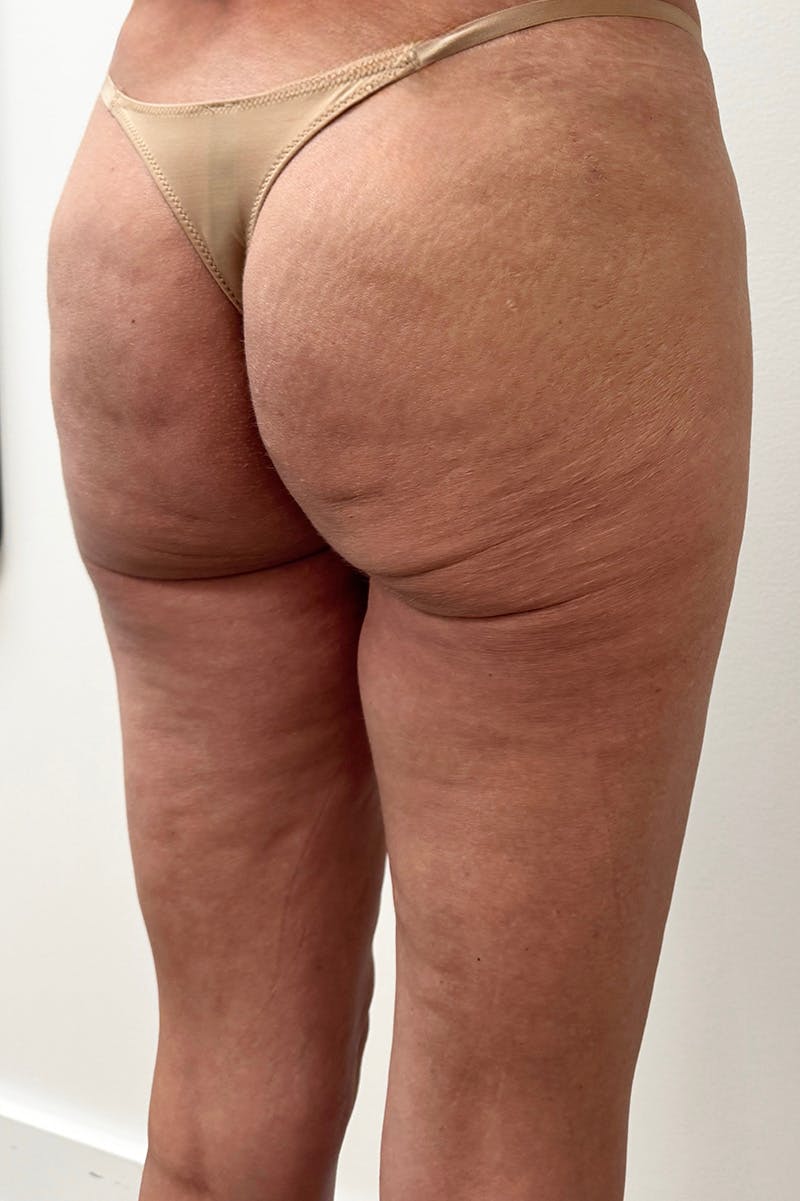 Biostimulator Before & After Gallery - Patient 940688 - Image 2