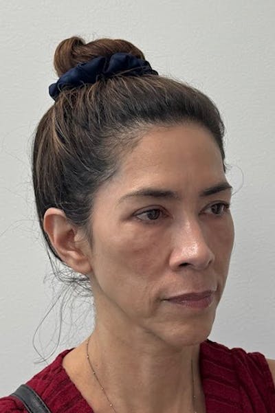 Biostimulator Before & After Gallery - Patient 172504 - Image 1