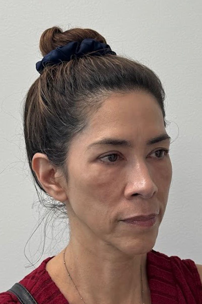 Biostimulator Before & After Gallery - Patient 172504 - Image 1