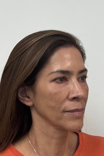 Biostimulator Before & After Gallery - Patient 172504 - Image 2