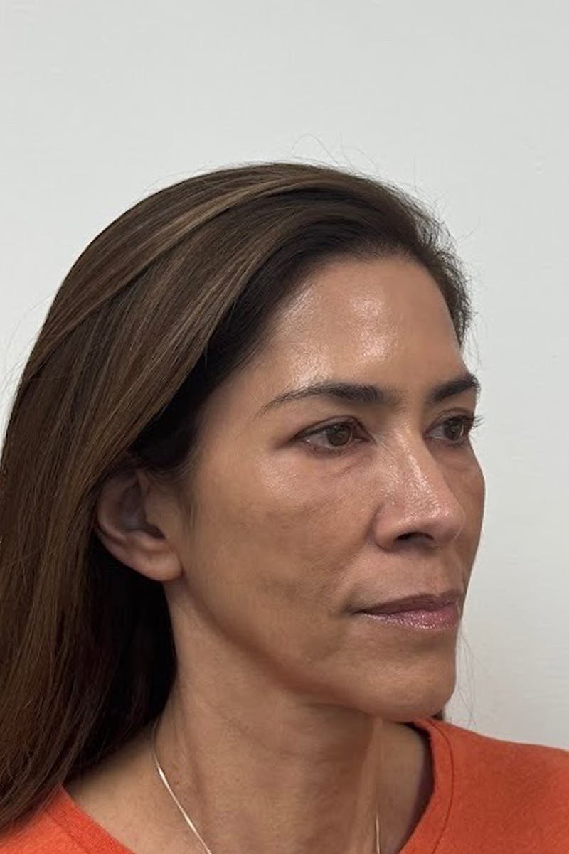 Biostimulator Before & After Gallery - Patient 172504 - Image 2