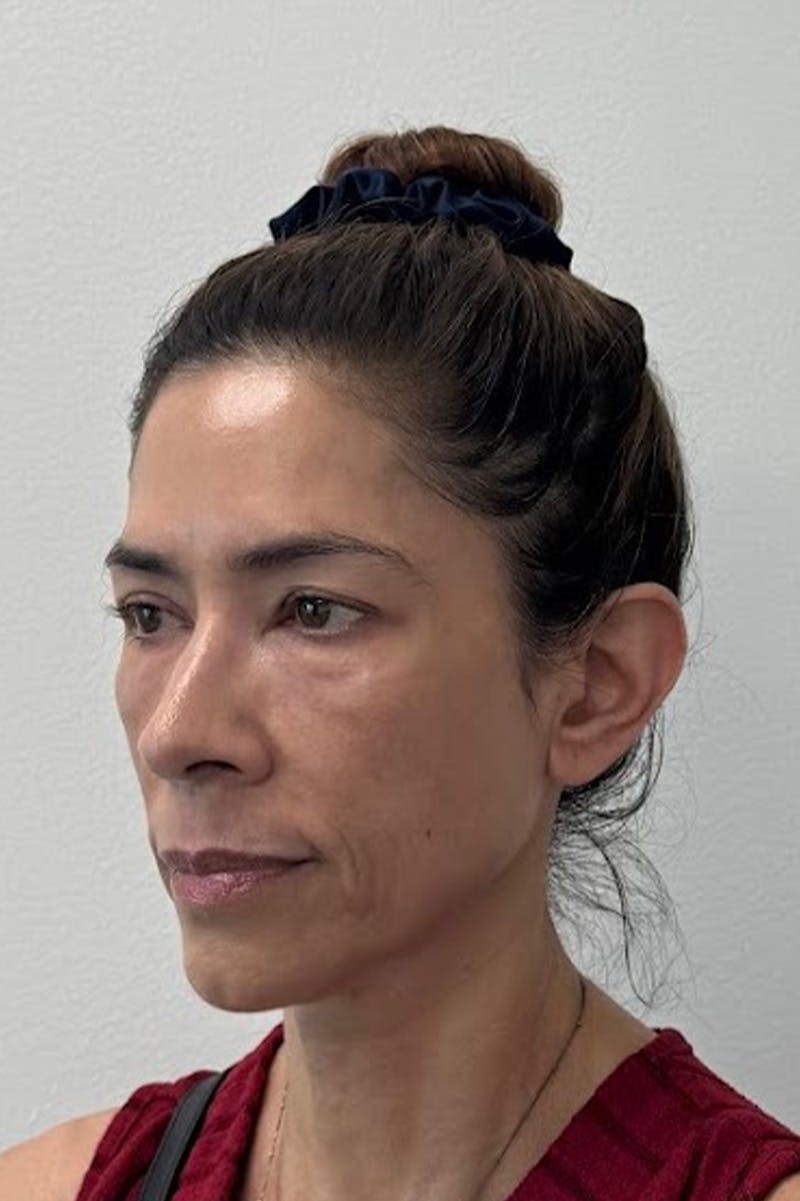 Biostimulator Before & After Gallery - Patient 172504 - Image 3