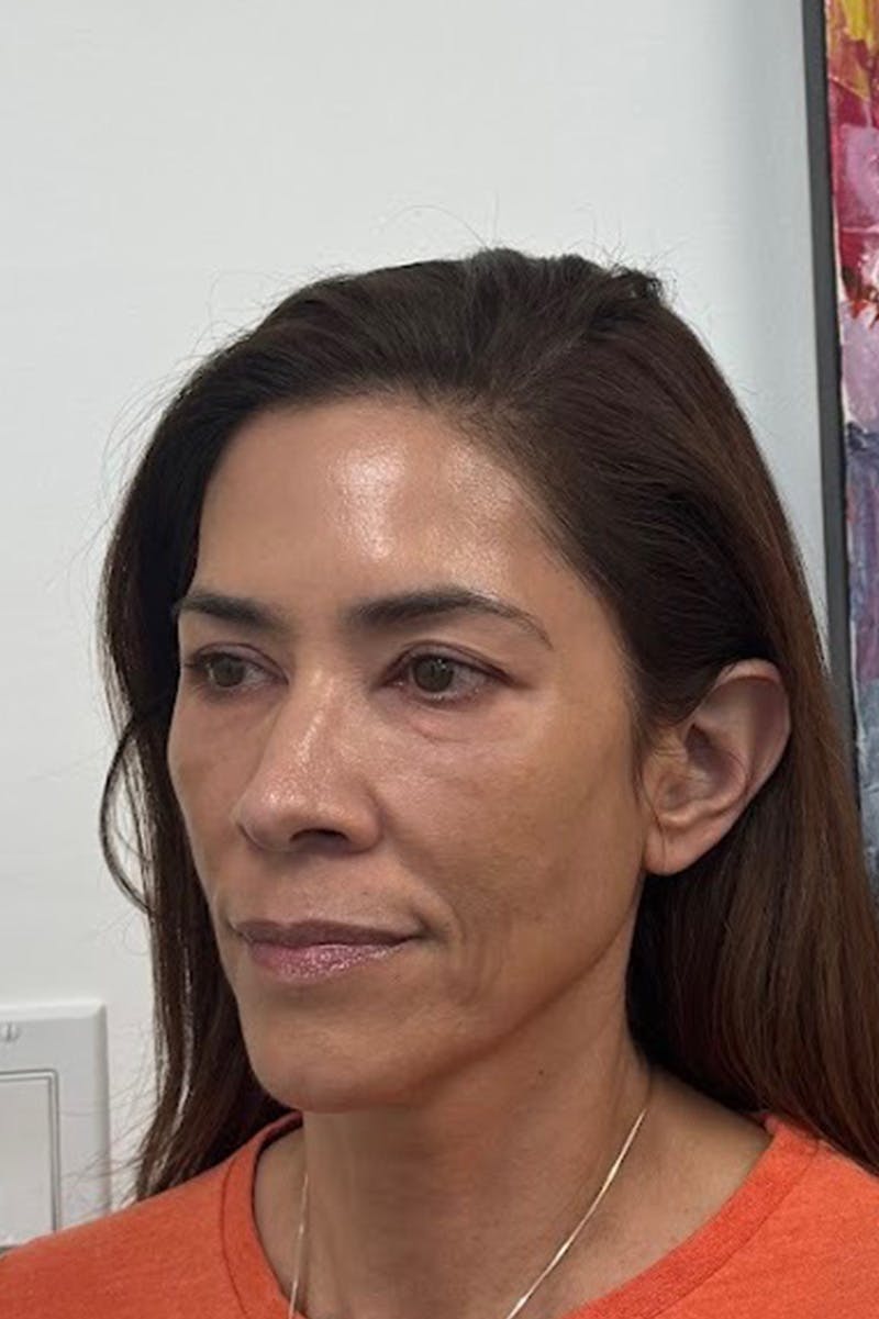 Biostimulator Before & After Gallery - Patient 172504 - Image 4