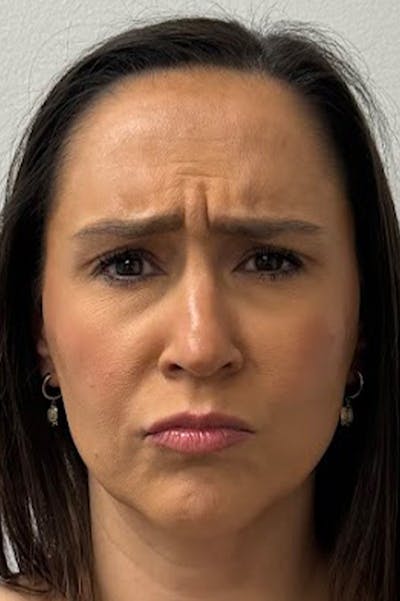 Injectables Before & After Gallery - Patient 325744 - Image 1