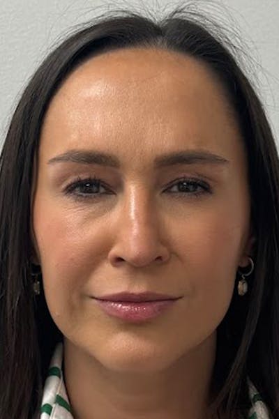 Injectables Before & After Gallery - Patient 325744 - Image 2