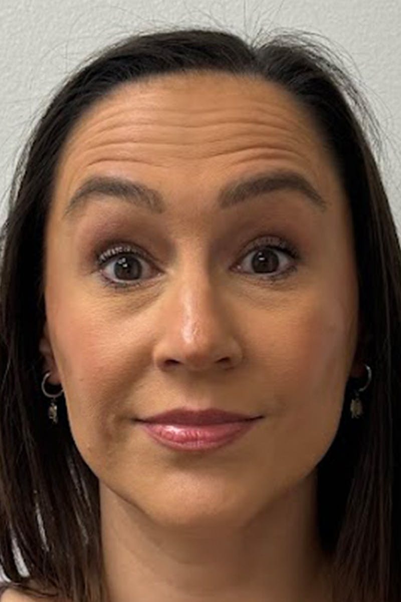 Injectables Before & After Gallery - Patient 325744 - Image 3