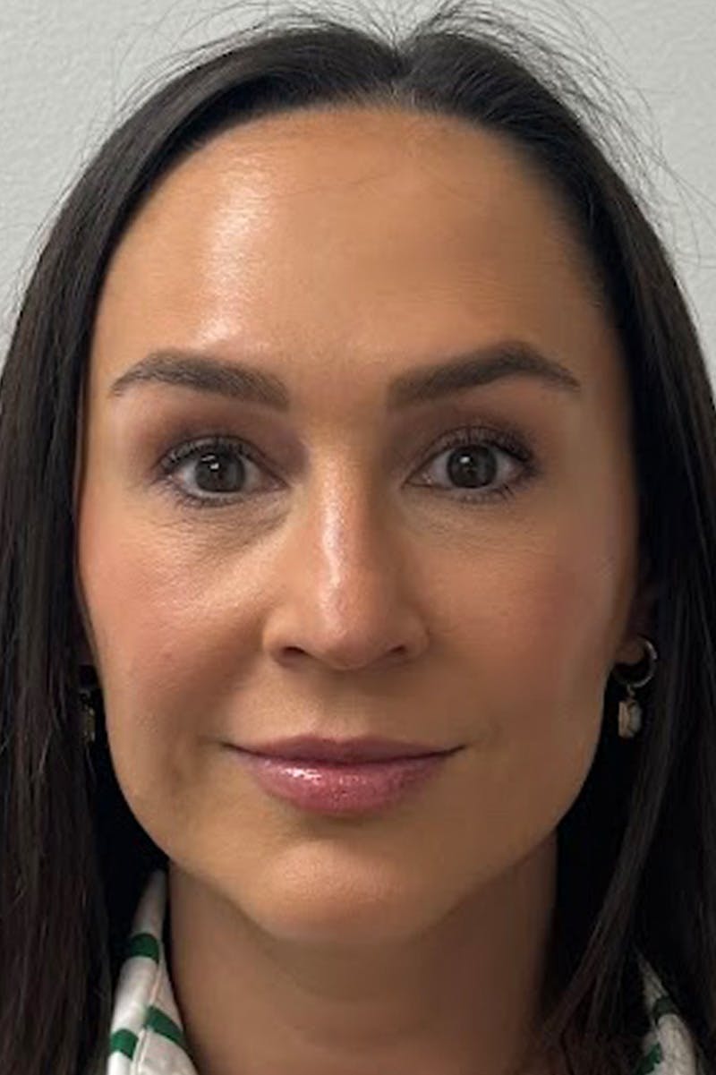 Injectables Before & After Gallery - Patient 325744 - Image 4