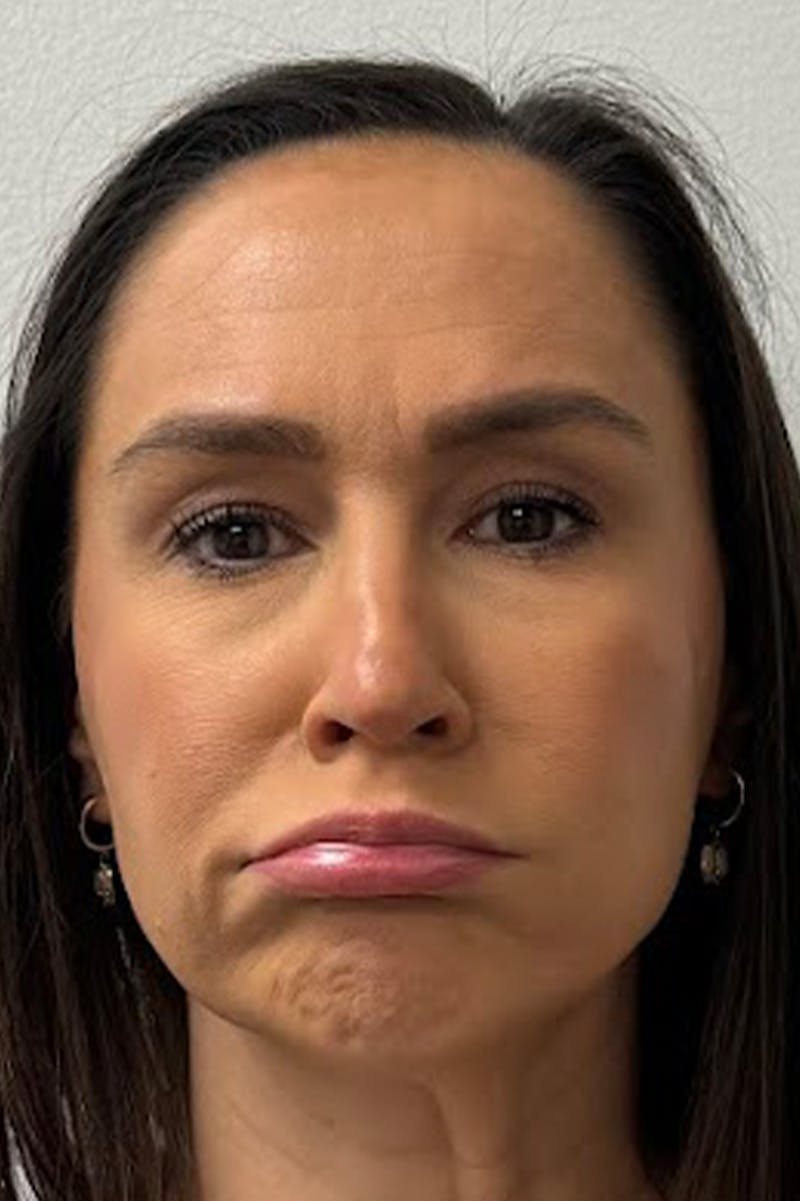 Injectables Before & After Gallery - Patient 325744 - Image 5