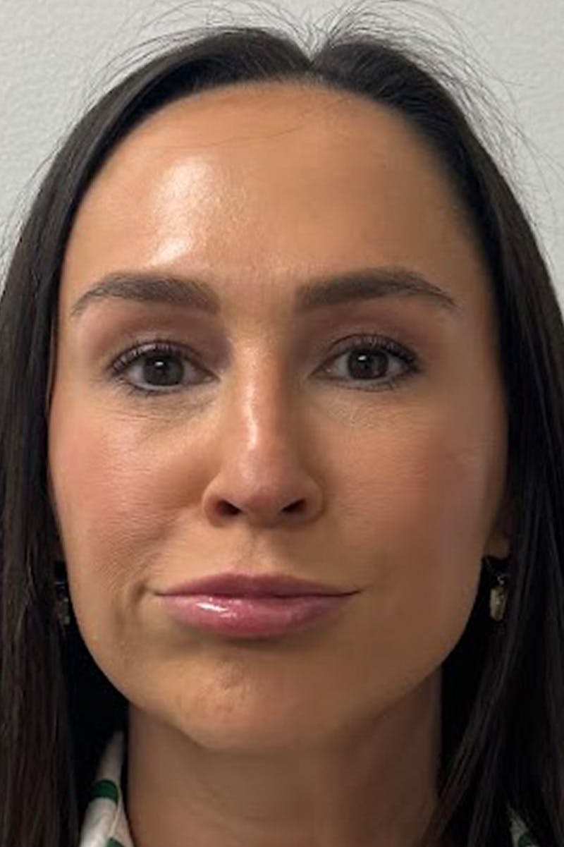 Injectables Before & After Gallery - Patient 325744 - Image 6