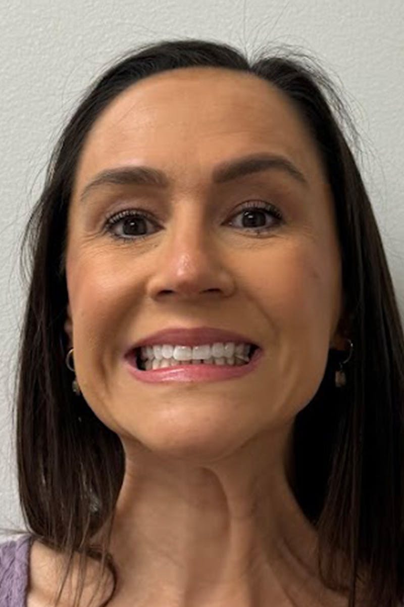 Injectables Before & After Gallery - Patient 325744 - Image 7