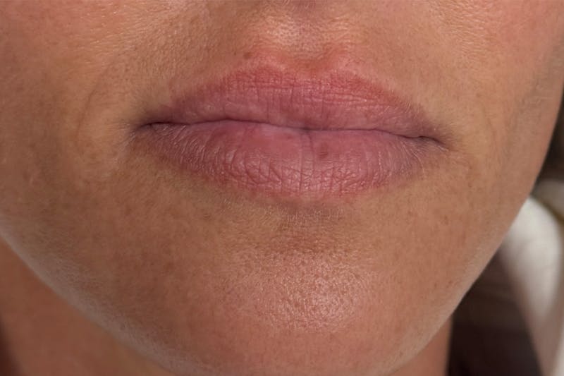 Injectables Before & After Gallery - Patient 297220 - Image 1