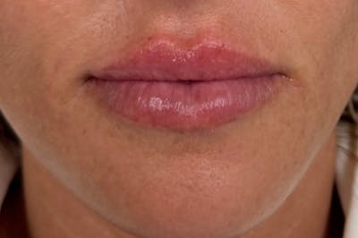 Injectables Before & After Gallery - Patient 297220 - Image 2