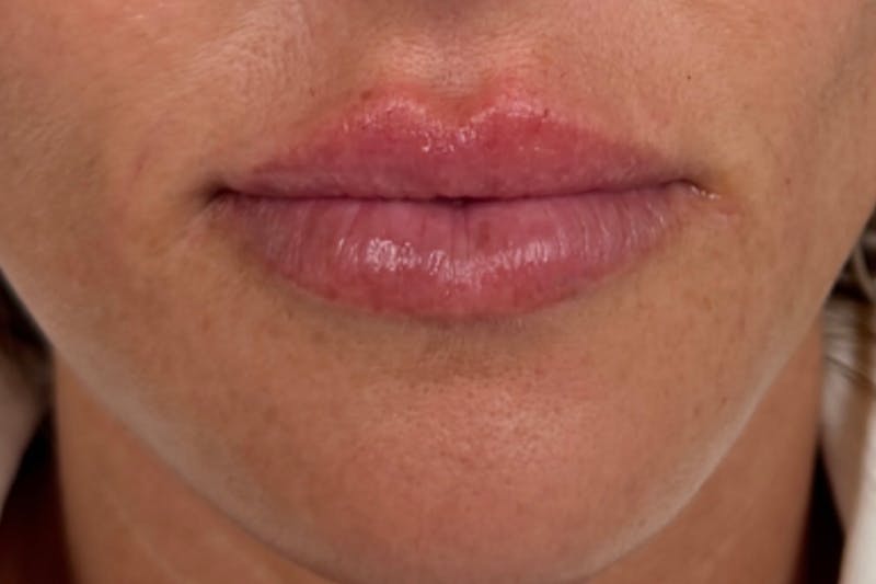 Injectables Before & After Gallery - Patient 297220 - Image 2