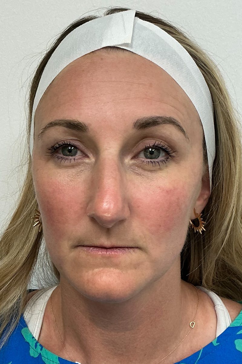 Laser Before & After Gallery - Patient 110151 - Image 1