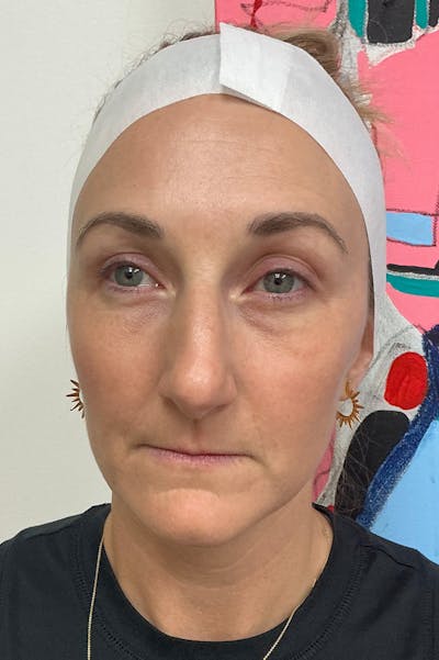 Laser Before & After Gallery - Patient 110151 - Image 2