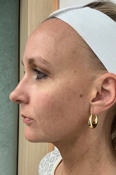 Laser Before & After Gallery - Patient 263326 - Image 1