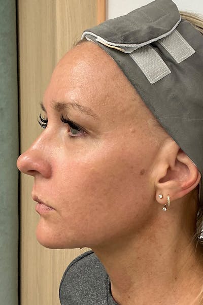 Laser Before & After Gallery - Patient 263326 - Image 2