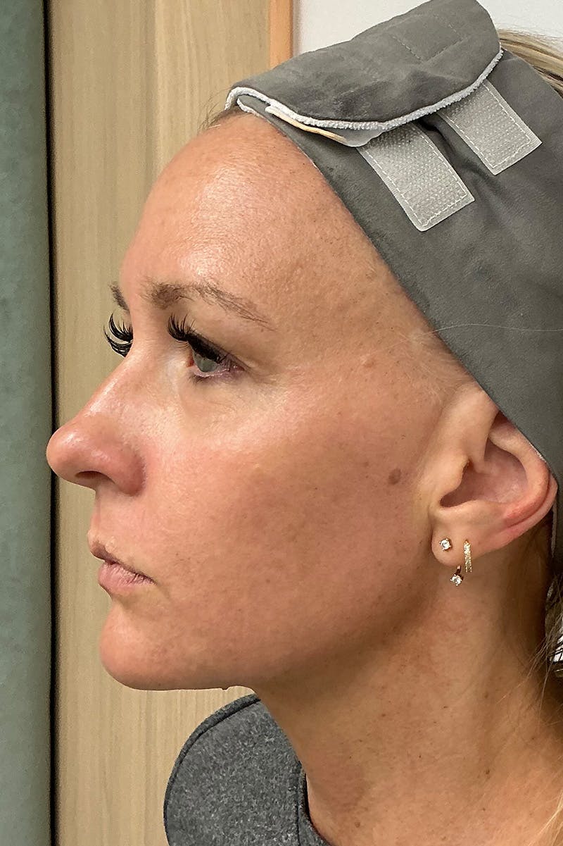 Laser Before & After Gallery - Patient 263326 - Image 2