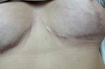 Laser Before & After Gallery - Patient 156520 - Image 1