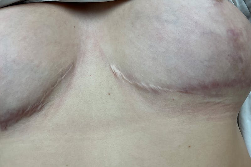 Laser Before & After Gallery - Patient 156520 - Image 1