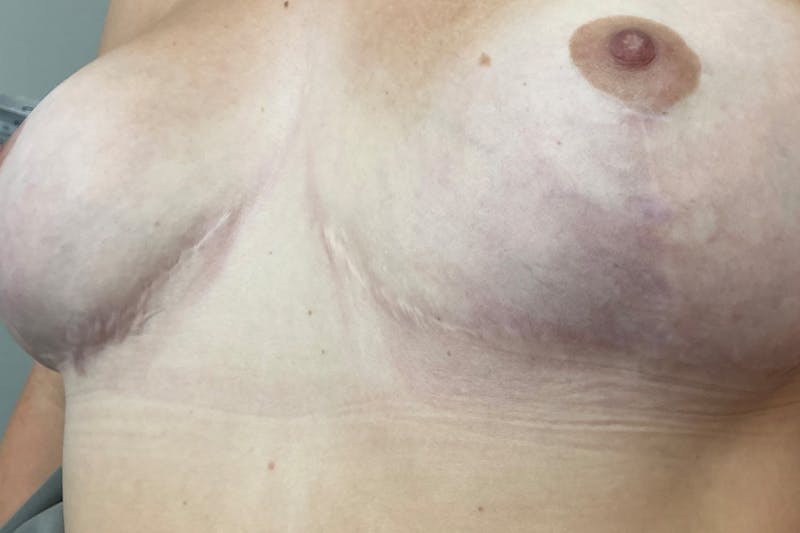 Laser Before & After Gallery - Patient 156520 - Image 2