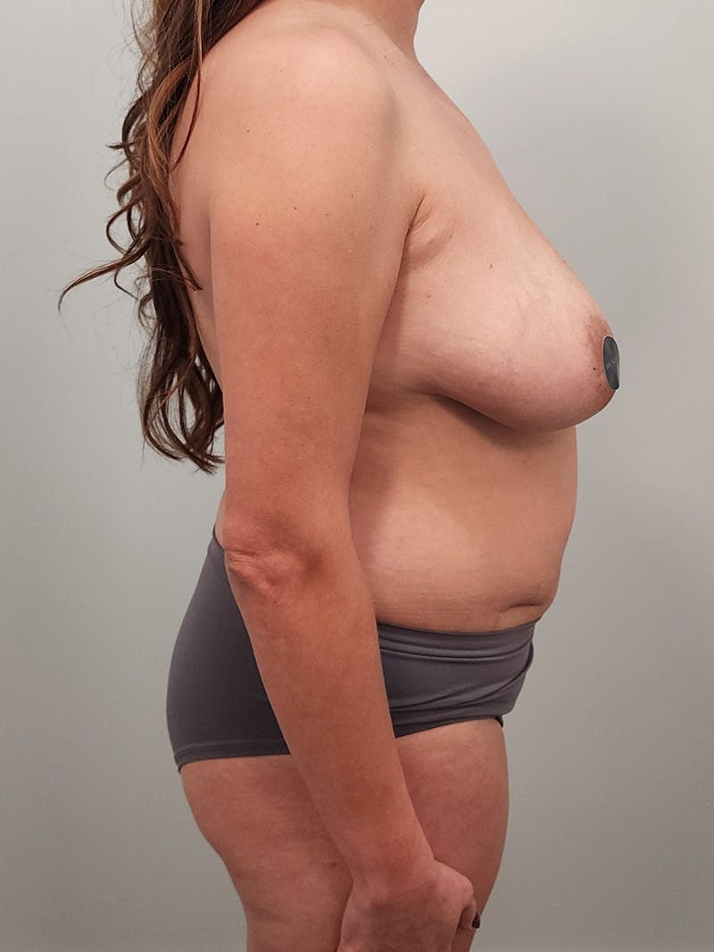 Mommy Makeover Before & After Gallery - Patient 381294 - Image 5