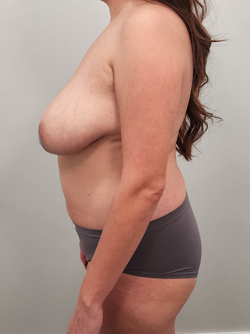 Mommy Makeover Before & After Gallery - Patient 381294 - Image 11