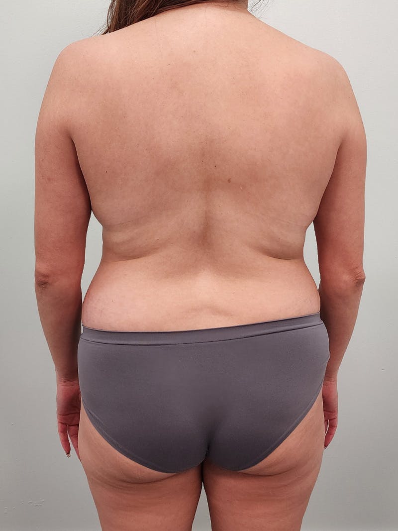 Mommy Makeover Before & After Gallery - Patient 381294 - Image 15