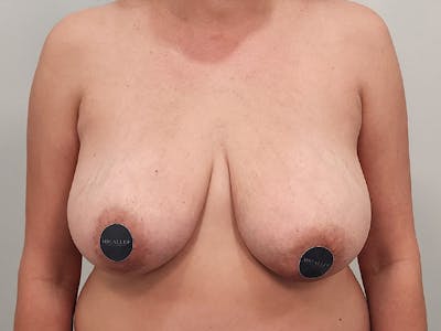 Breast Augmentation-Mastopexy Before & After Gallery - Patient 258178 - Image 1