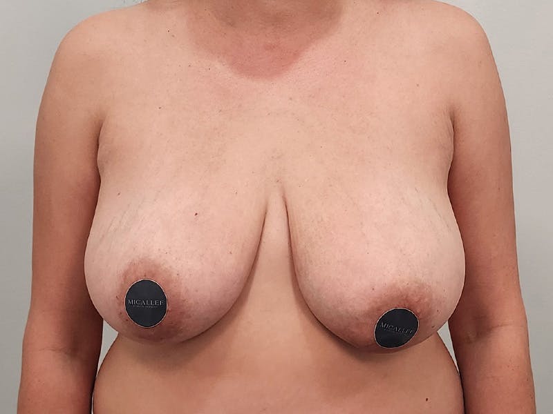 Breast Augmentation-Mastopexy Before & After Gallery - Patient 258178 - Image 1
