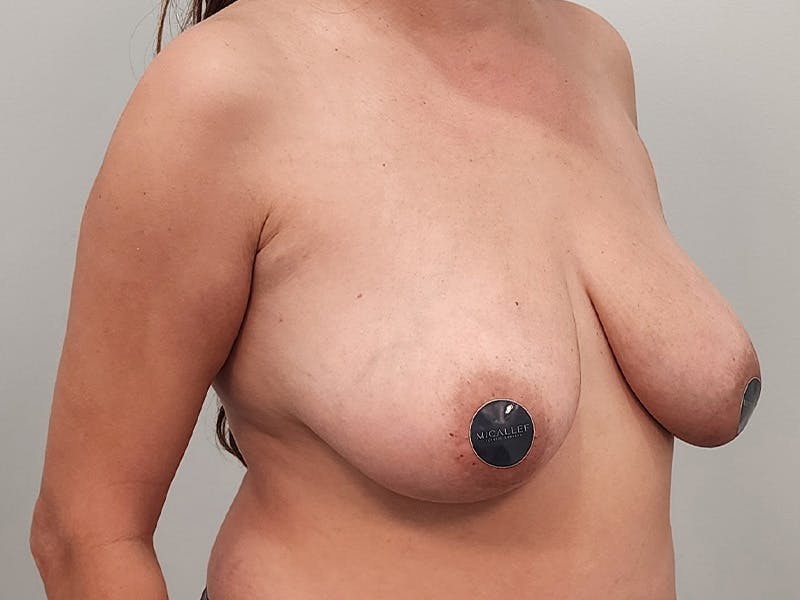 Breast Augmentation-Mastopexy Before & After Gallery - Patient 258178 - Image 3