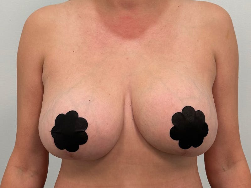 Breast Augmentation-Mastopexy Before & After Gallery - Patient 258178 - Image 2