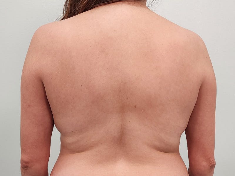 Breast Augmentation-Mastopexy Before & After Gallery - Patient 258178 - Image 15