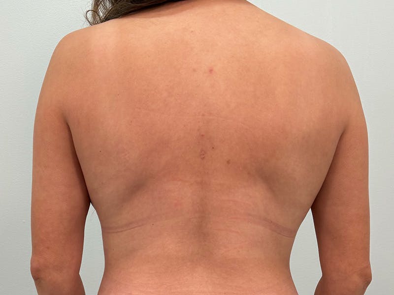 Breast Augmentation-Mastopexy Before & After Gallery - Patient 258178 - Image 16