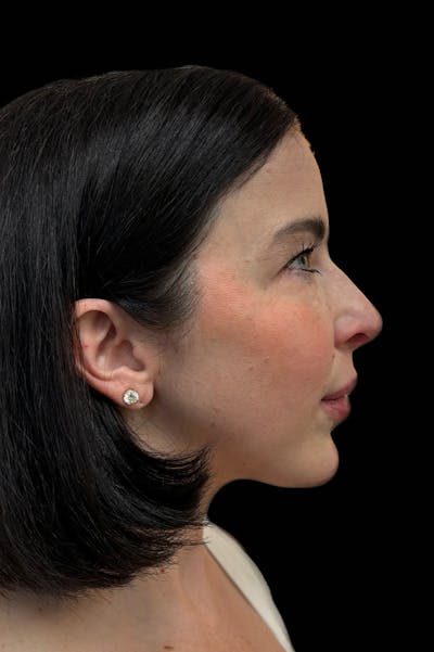 Facial Balancing Before & After Gallery - Patient 606711 - Image 1