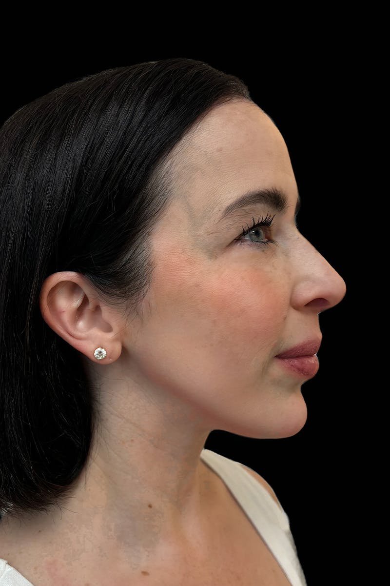 Facial Balancing Before & After Gallery - Patient 606711 - Image 2