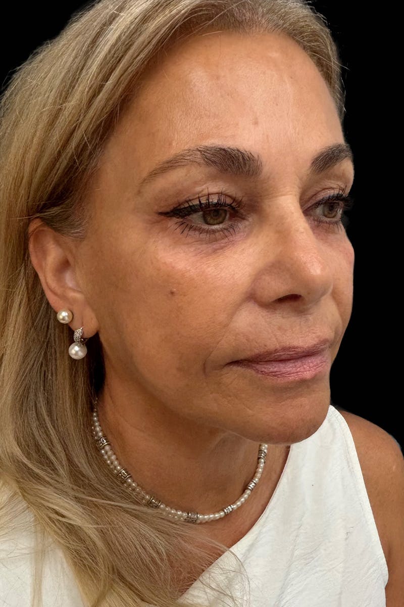 Facial Balancing Before & After Gallery - Patient 415472 - Image 1