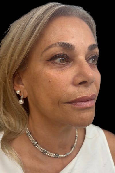 Facial Balancing Before & After Gallery - Patient 415472 - Image 2