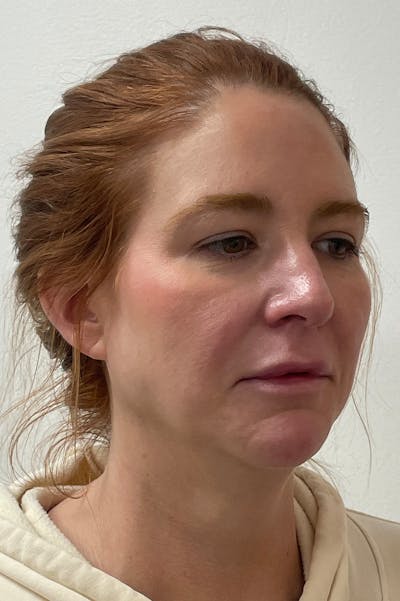 Facial Balancing Before & After Gallery - Patient 346873 - Image 1