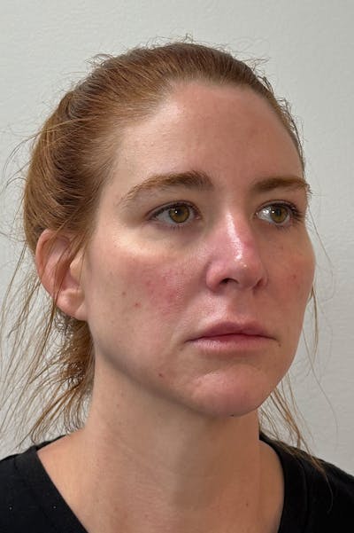 Facial Balancing Before & After Gallery - Patient 346873 - Image 2