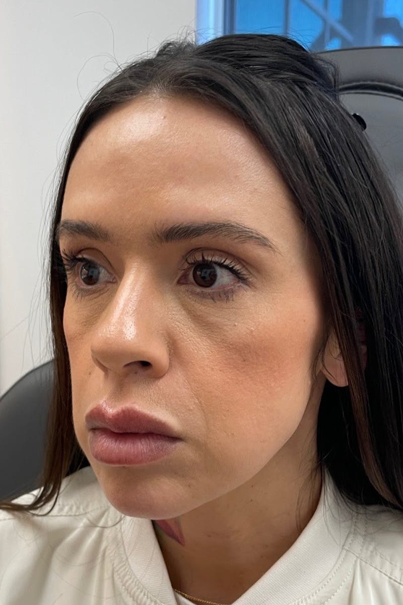 Facial Balancing Before & After Gallery - Patient 485022 - Image 1