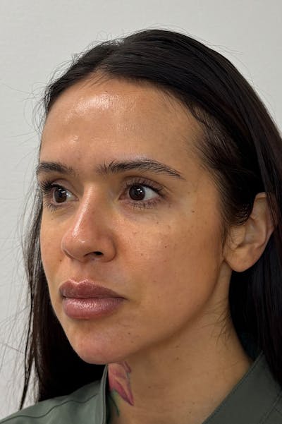Facial Balancing Before & After Gallery - Patient 485022 - Image 2
