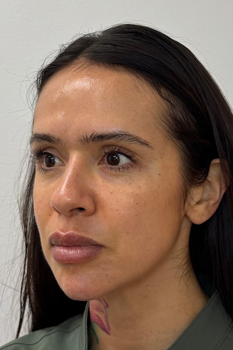 Facial Balancing Before & After Gallery - Patient 485022 - Image 2