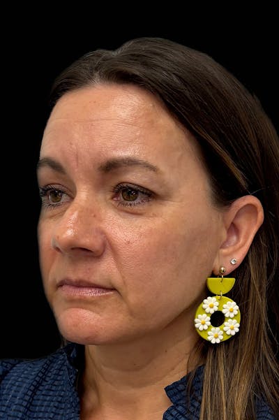 Facial Balancing Before & After Gallery - Patient 211360 - Image 1