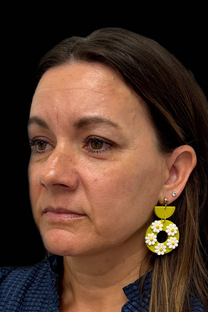 Facial Balancing Before & After Gallery - Patient 211360 - Image 1