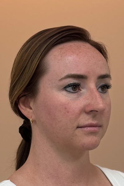 Facial Balancing Before & After Gallery - Patient 413212 - Image 1