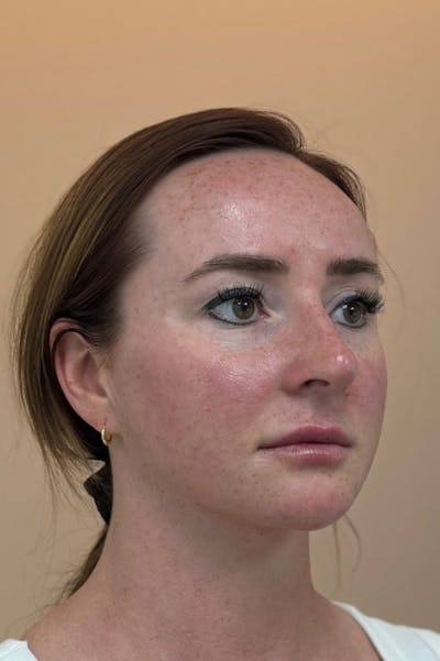 Facial Balancing Before & After Gallery - Patient 413212 - Image 2