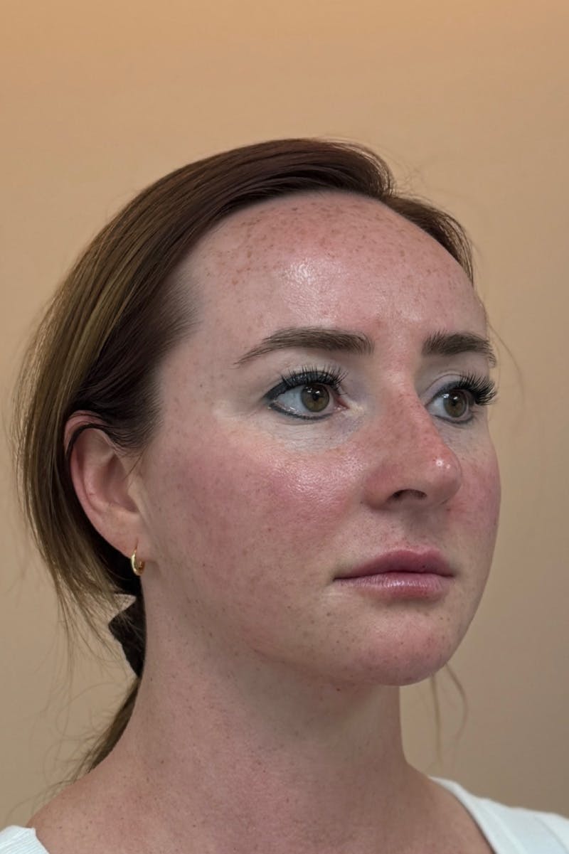Facial Balancing Before & After Gallery - Patient 413212 - Image 2