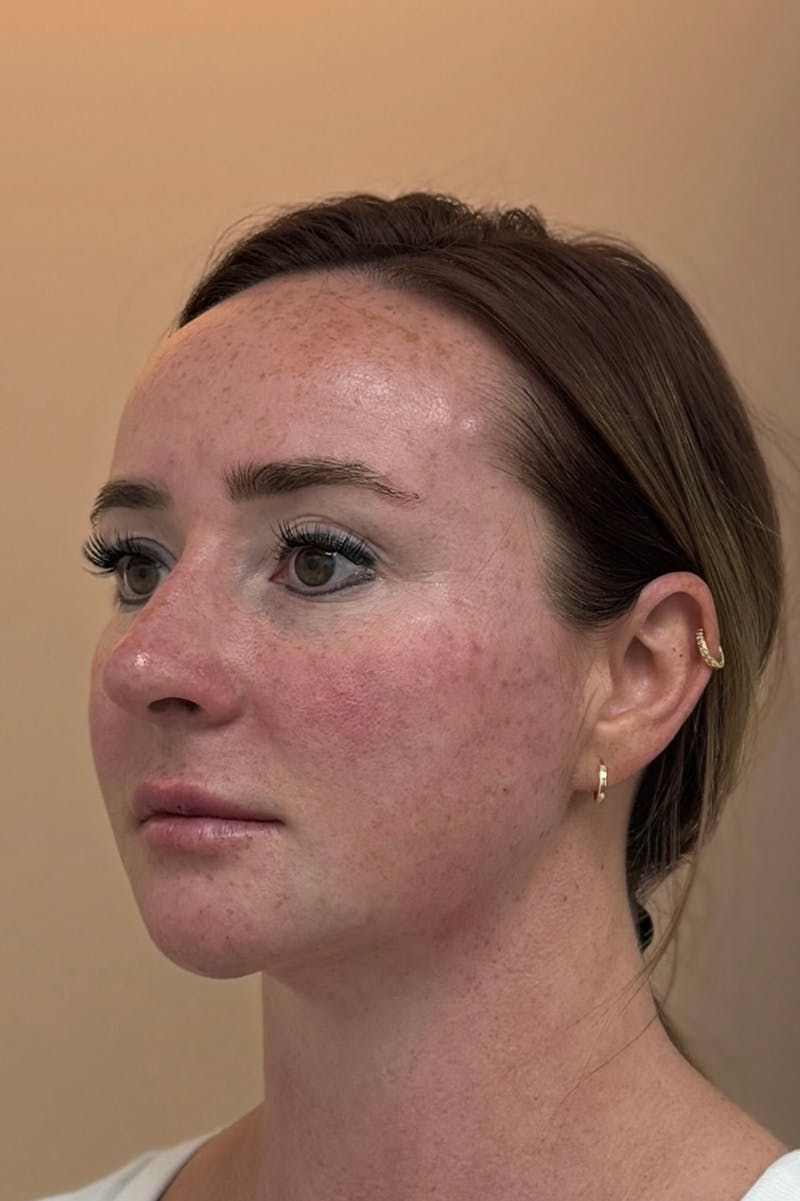 Facial Balancing Before & After Gallery - Patient 413212 - Image 4