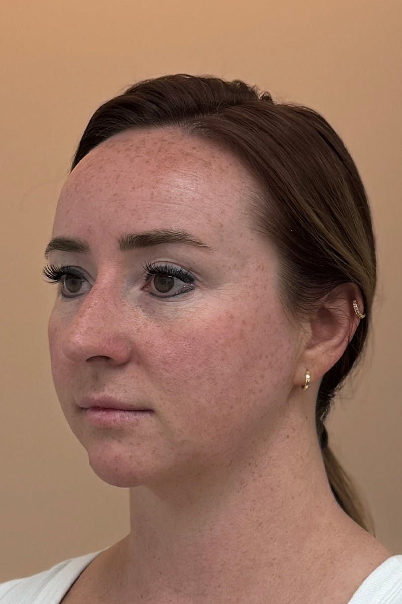 Facial Balancing Before & After Gallery - Patient 413212 - Image 3